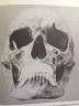 Mengele's skull, major dental work can been seen, suggesting that even Mengele pursued the dream of becoming the perfect human being 